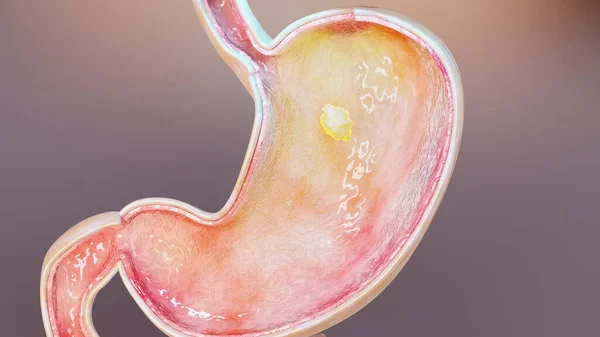Estómago Humano Con Gases Hinchazón Flatulencia Flatulencia Tracto Gastrointestinal Sistema —  Fotos de Stock