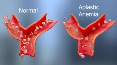 Anemi miktarı kan hücresi veya hemoglobin ve normal. Aplastik anemi, normal ve anormal kan hücresi ve trombosit sayısı, atardamar veya damarda dolaşım, anemi hastalığı, demir eksikliği, 3D render.