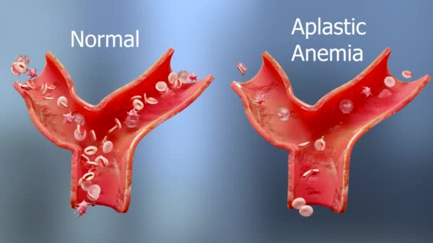 Anemia Amount Blood Cell Hemoglobin Normal Aplastic Anemia Normal Abnormal — Stock Video