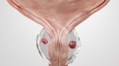 Prostat kanseri aşamaları. Kanser hücreleri, kötü huylu tümör üretrayı sıkıştırır. Patolojik bozulma, üreme sistemi anatomisi, mesane onkolojik veya ürolojik hastalıklar, bph, 3D render