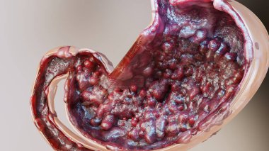 Mide kanseri. Sindirim sisteminde tümör büyümesi Peptik Ülser, kanser hücrelerine saldırıyor. Mide hastalığı konsepti. Belirtiler, kötü huylu kanser, virüsler ve bakteriler, çapraz kesit, 3 boyutlu görüntüleme