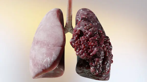 Zatürree Hastalığı Sağlıklı Akciğerler Hastalıklı Akciğerler Insan Akciğeri Kanseri Sigara Stok Resim