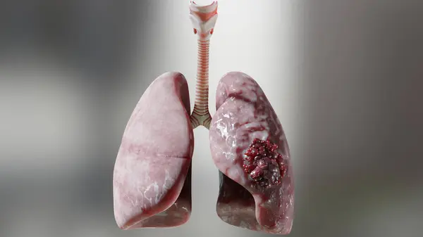 Zatürree Hastalığı Sağlıklı Akciğerler Hastalıklı Akciğerler Insan Akciğeri Kanseri Sigara Telifsiz Stok Imajlar