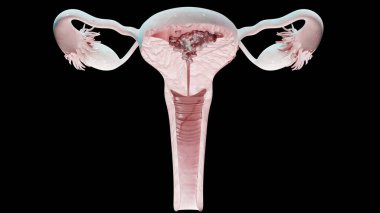 Üreme sistemi, kanser hücreleri, yumurtalık kistleri, rahim ağzı kanseri, büyüyen hücreler, jinekolojik hastalıklar, metastaz kanseri, ikileşme, üç boyutlu işleme