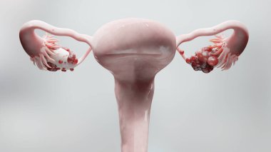 Yumurtalık tümörü, kadın rahim anatomisi, üreme sistemi, kanser hücreleri, yumurtalık kistleri, rahim kanseri, büyüyen hücreler, jinekolojik hastalıklar, metastaz kanseri, çoğalma, üç boyutlu işleme