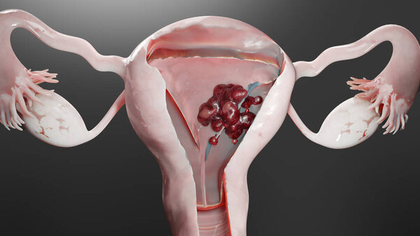 Reproductive system, cancer cells, ovaries cysts, cervical cancer, growing cells, gynecological disease, metastasis cancerous, duplicating, 3d render
