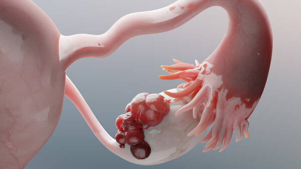 Ovarian malignant tumor, Female uterus anatomy, Reproductive system, cancer cells, ovaries cysts, cervical cancer, growing cells, gynecological disease, metastasis cancerous, duplicating, 3d render
