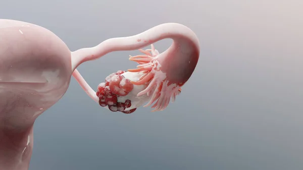 Yumurtalık tümörü, kadın rahim anatomisi, üreme sistemi, kanser hücreleri, yumurtalık kistleri, rahim kanseri, büyüyen hücreler, jinekolojik hastalıklar, metastaz kanseri, çoğalma, üç boyutlu işleme