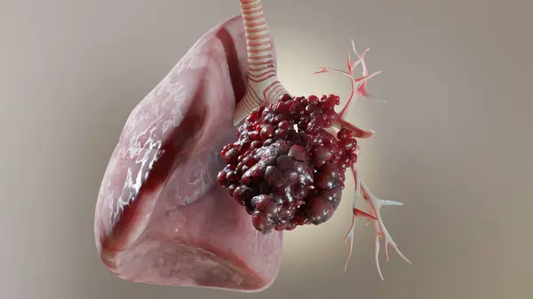 Pneumonia illness, healthy lungs and disease lungs, Human Lungs cancer, Cigarette smokers Lung disease, cancerous malignant tumor growing and spreading, respiratory system, asthma infection, 3d render