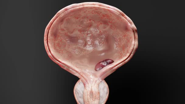ブレイダーガンの段階 先祖細胞 悪性腫瘍は 尿道を圧縮する 病理学的混乱 生殖器系の解剖学 膀胱腫瘍または泌尿器疾患 Bph 3Dレンダリング — ストック動画