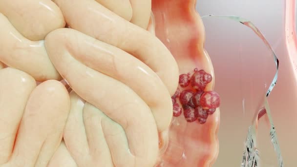 肠癌或大肠癌 结肠癌 肠道疼痛 腹腔感染 细胞扩张 恶性肿瘤 — 图库视频影像