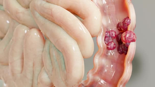 腸がんまたは大腸癌 腸がん 腸炎症性腸疾患 セリアック 感染症 細胞の拡大 悪性がん ウイルス 3Dレンダリング — ストック動画