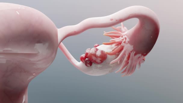 卵巣悪性腫瘍 女性子宮解剖学 生殖器系 がん細胞 卵巣細胞 子宮頸がん 成長細胞 婦人科疾患 転移がん 3Dレンダリング — ストック動画