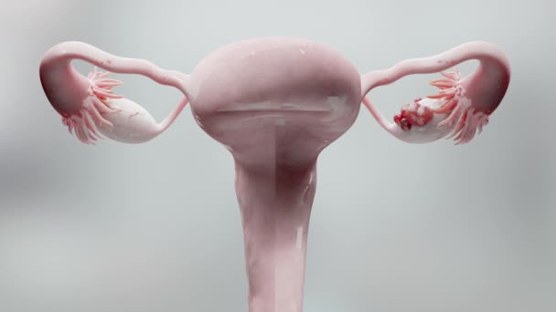 Petefészek Rosszindulatú Daganat Női Méh Anatómia Reproduktív Rendszer Rákos Sejtek — Stock videók