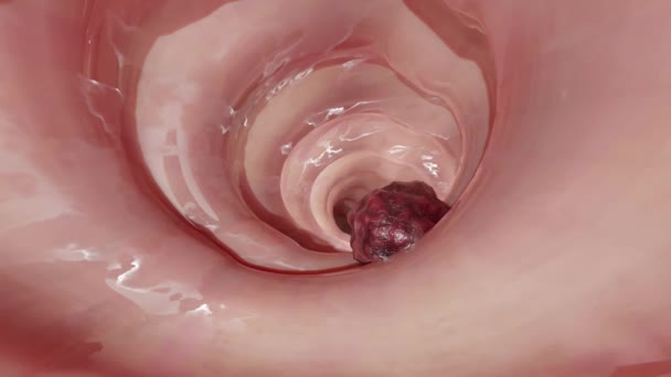 腸がん 腸内の悪性腫瘍 腸内内内内視鏡 腸腸管 コロンポリープ除去 コロニーポリープの検索 ポリペクチミン 腸がん 腸内新生物 3Dレンダリング — ストック動画