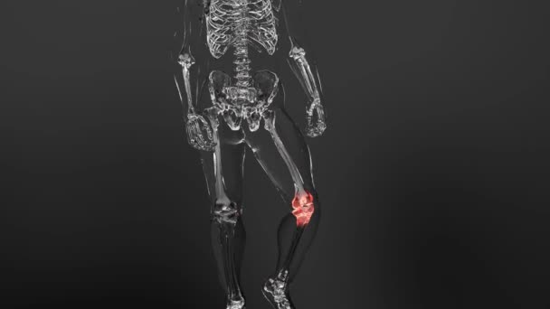 Douleur Dans Articulation Genou Arthritique Douleur Genou Radiographie Squelette Arthrite — Video