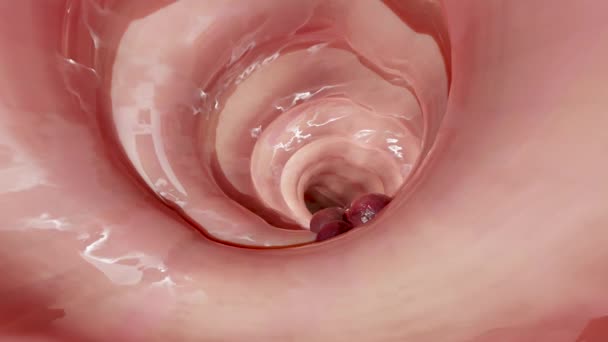 Cancro Colorretal Tumor Maligno Intestino Endoscópio Dentro Colonoscopia Intestino Intestino — Vídeo de Stock