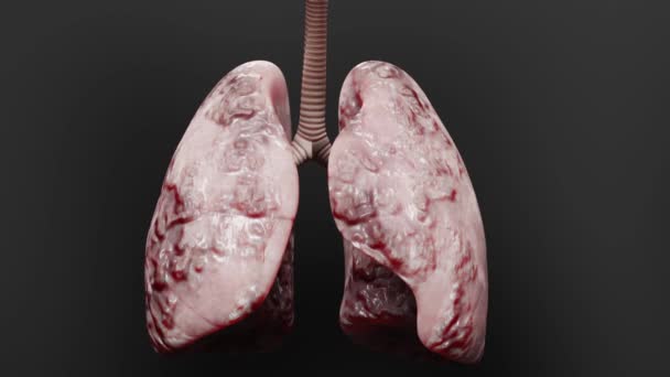 Pneumonie Zdravé Plíce Onemocnění Plic Lidský Karcinom Plic Kuřáci Cigaret — Stock video