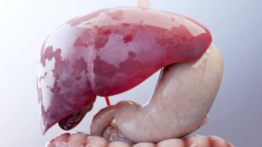 Sindirim Organ Karaciğeri Kanseri, Hepatit sirozu habis tümör, Hepatik yetmezliği, büyüme hücreleri, çoğalma, fibroz, siroz, Hepatosel karsinom, Virüs enfekte olmuş karaciğer, insan, 3D