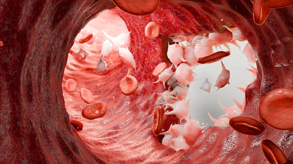 stock image Hemostasis. Red blood cells and platelets in the blood vessel, vasoconstriction, wound healing process. hemorrhage clot embolisms, Hemophilia. fibrinolysis, injury bleeding coagulation, 3d render