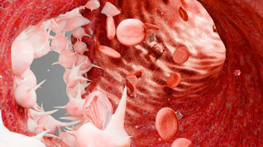 Hemostasis. Kan damarlarında kırmızı kan hücreleri ve trombositler, vazokonstrüksiyon, yaraların iyileşme süreci. Pıhtı embolisi, hemofili. Fibrinolysis, yaralanma, pıhtılaşma, 3 boyutlu görüntüleme.