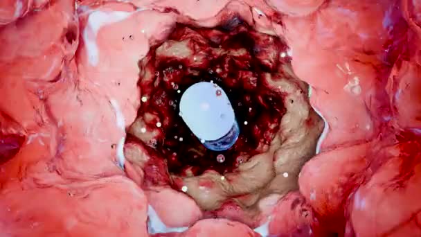 Запальна Хвороба Кишечника Колоректальна Рак Злоякісна Пухлина Ендоскопічна Колоноскопія Кишковий — стокове відео