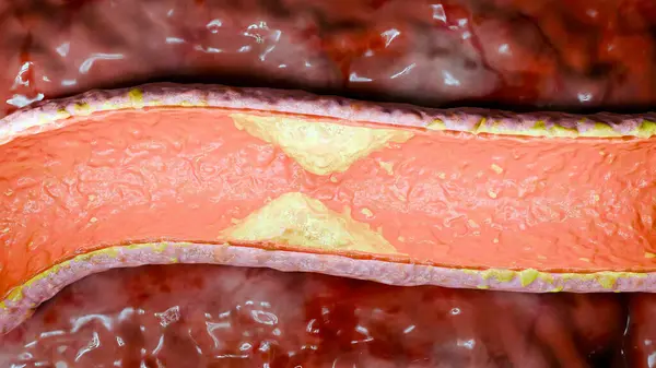 stock image Cholesterrol or Atherosclerotic Plaque in blood vessels, Blocked vessel stroke, Thickened Arteries and Veins, Coronary, fat buildup clogging, Atherosclerosis or atheromatous Hyperlipidemia, 3d render