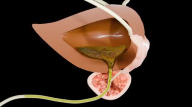 İyi huylu protez, prostat büyümesi ve iltihaplanması, hipertropi, hiperplazma (BPH), erkek üreme sistemi, mesane anatomisi, üroloji, genişletilmiş prostat bezi, Prostatitis, 3D render.