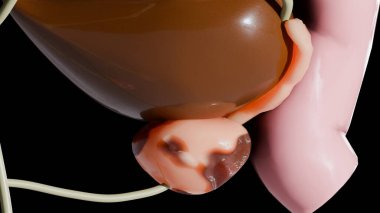 Prostat kanseri aşamaları. Kanser hücreleri, kötü huylu tümör üretrayı sıkıştırır. Patolojik bozulma, üreme sistemi anatomisi, mesane onkolojik veya ürolojik hastalıklar, bph, 3D render