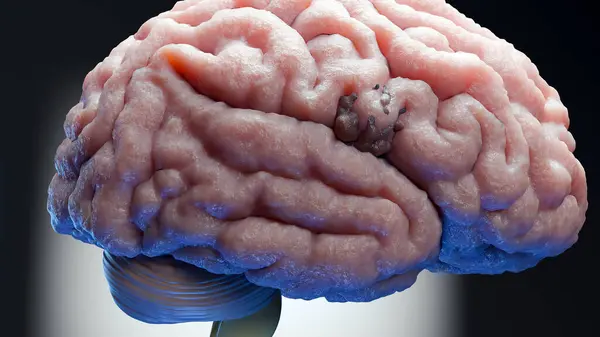 İnsan beyin sinir sistemi anatomisi, sinirsel kanser, yağlı ampul, beyin kanseri tümörü habis hücreler büyüyüp yayılıyor, menenjiyom, nörolojik hastalık, metastaz kanseri, serebrum, 3D render