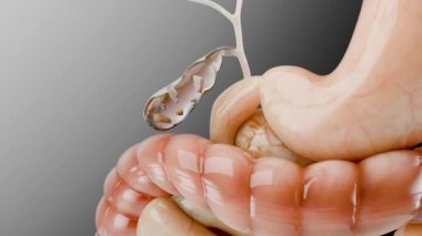 Gallstones in the gallbladderand bile duct, human silhouette and anatomy of surrounding organs, liver and gallbladder with stones, Realistic 3D Render