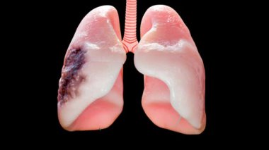 Zatürree hastalığı, sağlıklı akciğerler ve hastalıklı akciğerler, insan akciğeri kanseri, alfa kanalı, sigara içenler akciğerler, büyüyen ve yayılan kanserli tümör, solunum sistemi, astım enfeksiyonu, 3D rende