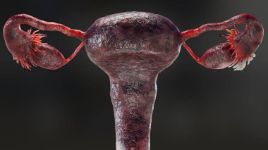 Yumurtalık tümörü, kadın rahim anatomisi, üreme sistemi, kanser hücreleri, yumurtalık kistleri, rahim kanseri, büyüyen hücreler, jinekolojik hastalıklar, metastaz kanseri, çoğalma, üç boyutlu işleme