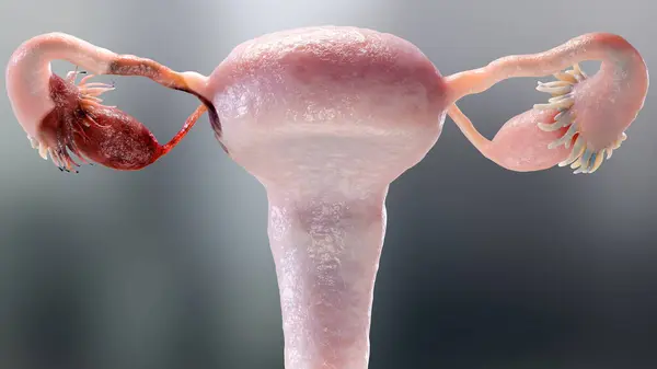 Yumurtalık tümörü, kadın rahim anatomisi, üreme sistemi, kanser hücreleri, yumurtalık kistleri, rahim kanseri, büyüyen hücreler, jinekolojik hastalıklar, metastaz kanseri, çoğalma, üç boyutlu işleme