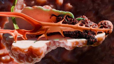 Pankreas hastalığı, sindirim bezi, pankreas kanseri anatomisi diyagramı, tıbben doğru, büyüyen ve yayılan kötü huylu tümör, mutasyona uğramış hücreler, metastaz kanseri, 3 boyutlu görüntüleme.