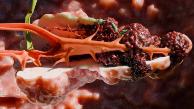 Pankreas hastalığı, sindirim bezi, pankreas kanseri anatomisi diyagramı, tıbben doğru, büyüyen ve yayılan kötü huylu tümör, mutasyona uğramış hücreler, metastaz kanseri, 3 boyutlu görüntüleme.