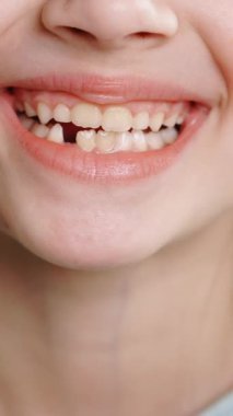 Dişsiz bir gülümsemeyle gülümseyen küçük bir kızın portresinin dikey format videosu. Süt dişlerinin dökülmesi, kalıcı dişlerin değiştirilmesi. Çocuklar dişçidir. Dişlerini gösterme. Süt dişini çıkar.