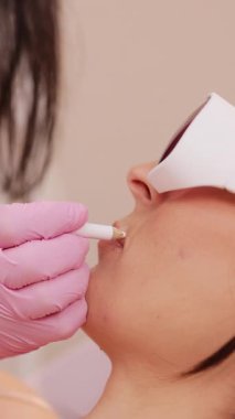 Laser saç temizleme uzmanının dikey videosu koruyucu kalemle kadının yüzündeki benleri çiziyor. Eldivenli kadın elleri, bölgeyi bir kalemle epilasyon ve benlerin korunması için işaretliyor..