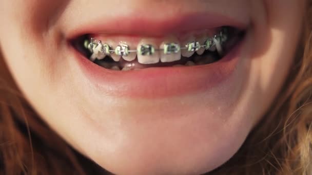 女性はブレースシステムで笑顔 ストーモロジー歯歯科クローズアップ 矯正ルーチン 高品質4K映像 — ストック動画