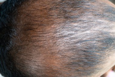 Arkadan gelen yetişkin bir adamın kel kafası. Kafada Alopecia var. Siyah Asyalı bir adamın kel kafası. Erkeklerde saç kaybı