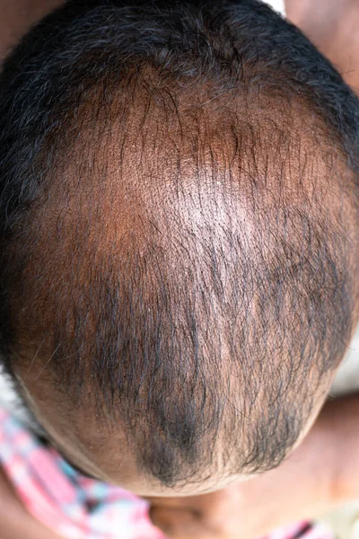 Bald head of a black asian man. Hair loss in men