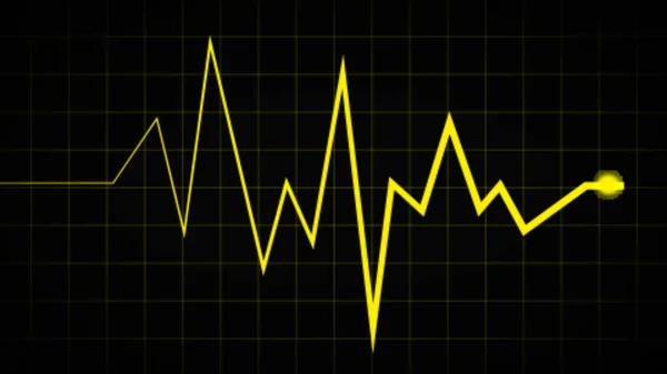 Schnell Langsame Unregelmäßige Herzschlagwellen Ecg Sinusrhythmusvektordiagramm Illustration Für Die Kardiologie — Stockfoto