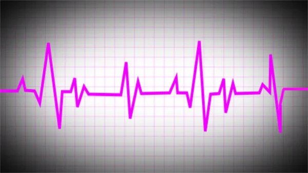 Een Elektrocardiogram Onthult Patroon Van Sinus Tachycardie Fibrilleren Van Het — Stockfoto