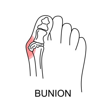 Ayak düzleminde nasır. Kırmızı lekeli ayak izlerinin soyut asgari çizimi acıdan muzdariptir. İlaç ya da valgus deformasyonu ya da nasır tedavisi için tasarım şablonu