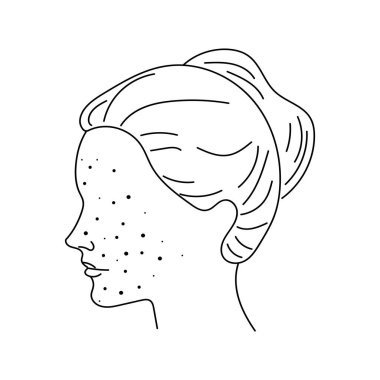 Yüzünde sivilceler olan bir kız. Sivilceli bir kadının doğrusal kafası. Sivilceli bir kadın, sivilceler, kızarık çizgisel piktogram. Dermatolojik sorun, alerji, iltihaplanma deri hatları ikonu. vektör