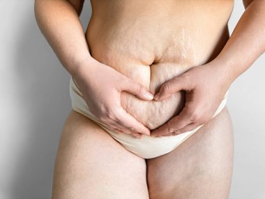 Doğum sonrası kadın, elleri karnında gerilme izleriyle kalp şekli yaratıyor. Vücut pozitifliği, kendini sevme, annelik ve hamilelik sonrası konsepti. Yüksek kalite fotoğraf