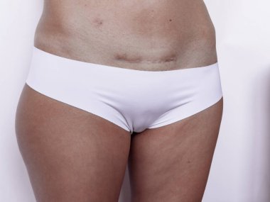 Karnında beyaz iç çamaşırlı cerrahi yara izi var..