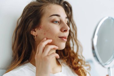 Derisi sorunlu genç bir kadın aynaya bakıyor. Dermatoloji. Kozmetik, kırmızı nokta ya da yüzündeki kızarıklıktan kaynaklanan alerjik reaksiyon. Güzellik bakımı. 