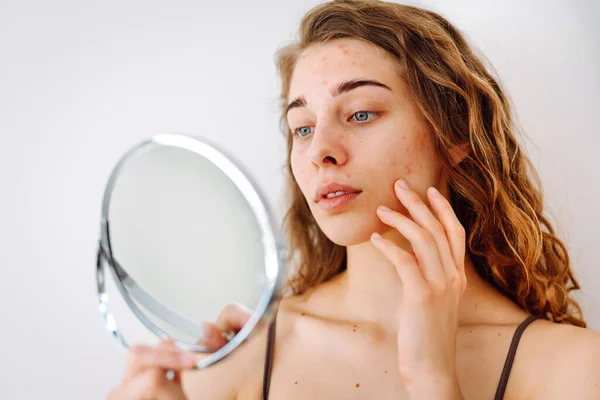 stock image Skin problem. Curly woman touches red inflammations on her face while looking in the mirror in a bright room. Facial skin problems. Beauty care. Allergic reaction.