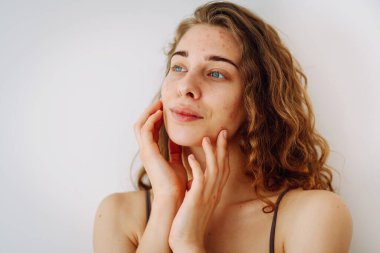 Kusurlu ciltli makyajsız güzel bir kadının yakın plan portresi. Sivilce derisi. Doğal güzellik. Tıp ve kozmetoloji.